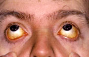 Symptom of anaemia