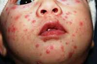 Chicken pox rash