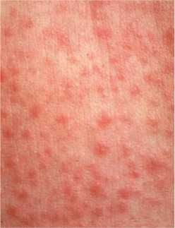 Measles rash