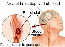 Diagram of a stroke in the brain