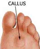 Callus on a foot